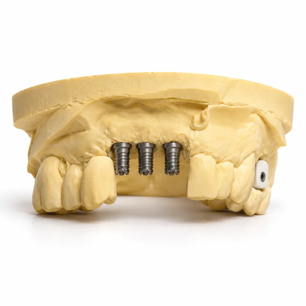 The stone model from the front: three implant analogs in a row where the bridge will sit