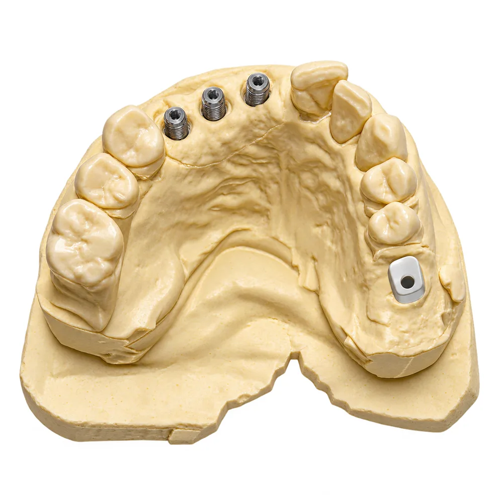 The same model from above: the three analogs in the arch, with a scan body on a back tooth