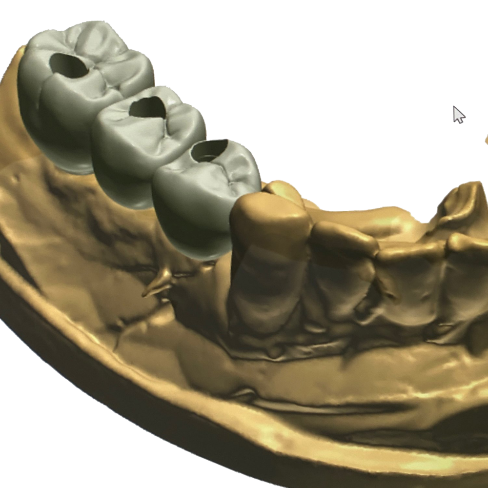 Ceramics Dental Lab Miami CAD CAM digital Impressions