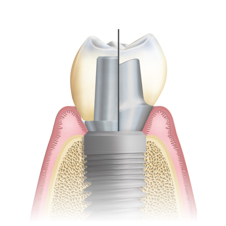 Implants Ceramics Dental Lab North Miami Beach