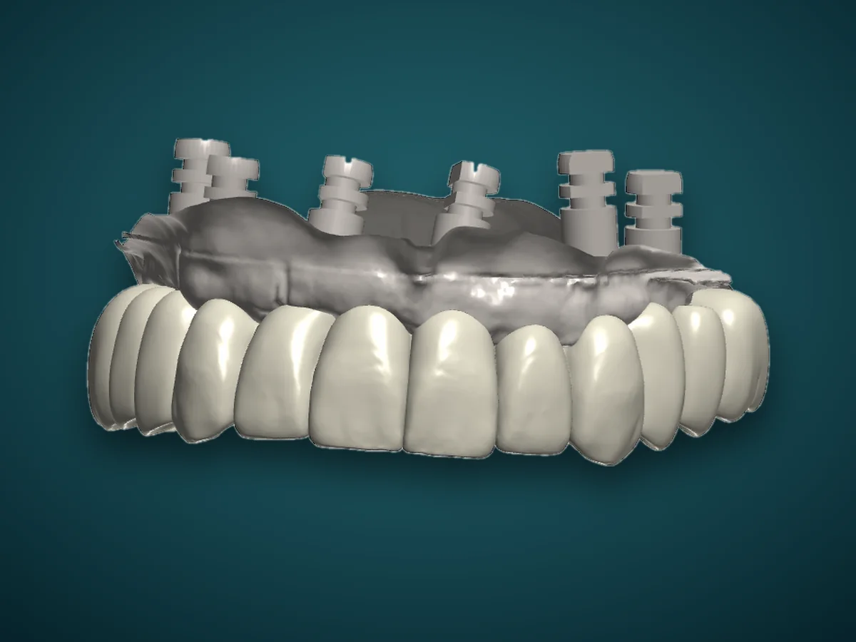 A full-arch hybrid design seated on its implant connections