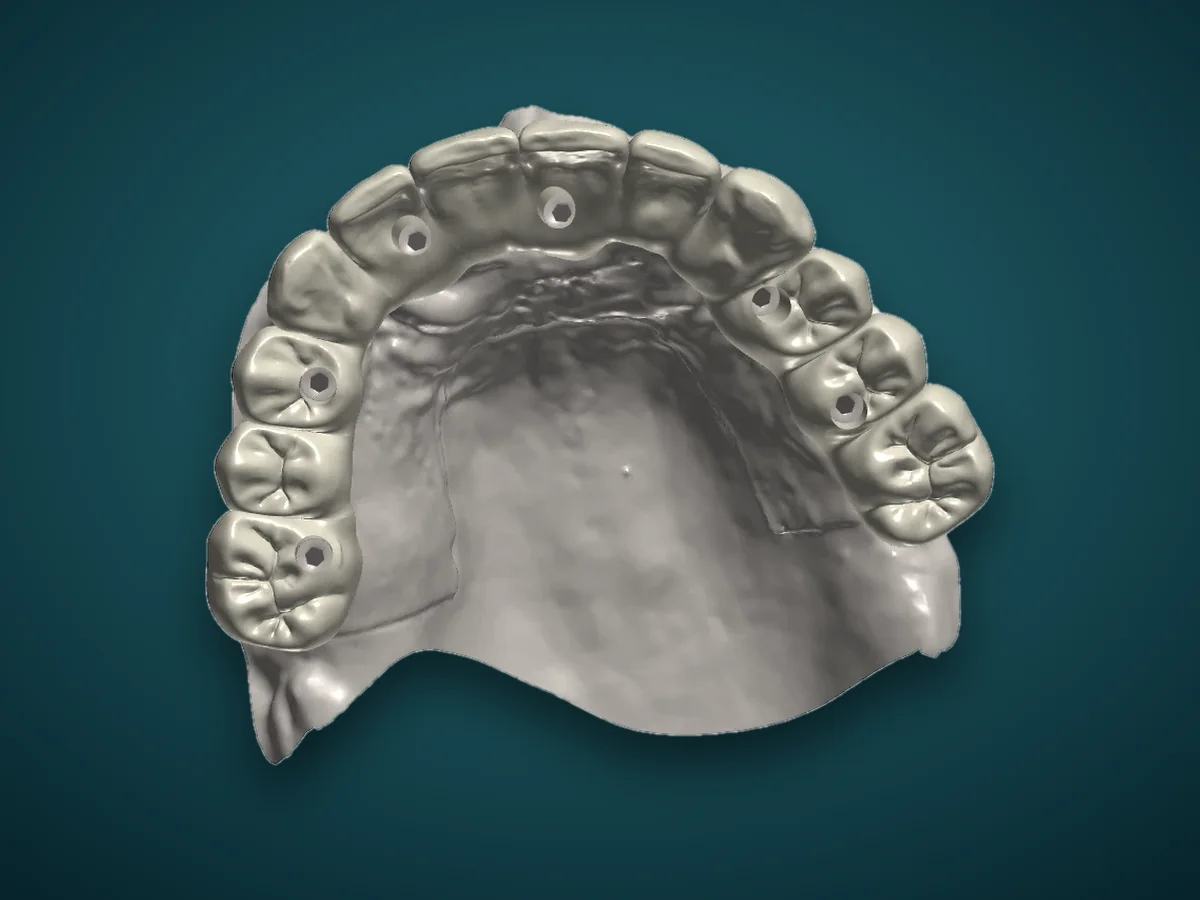 A full-arch hybrid design seen from the biting side, with screw access